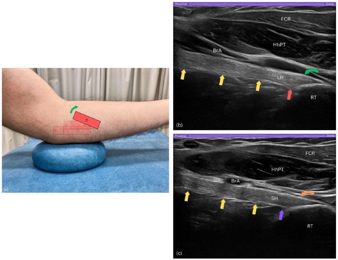 Tendon distal biceps 7 2 Tempo Formacion Ecografia.jpg